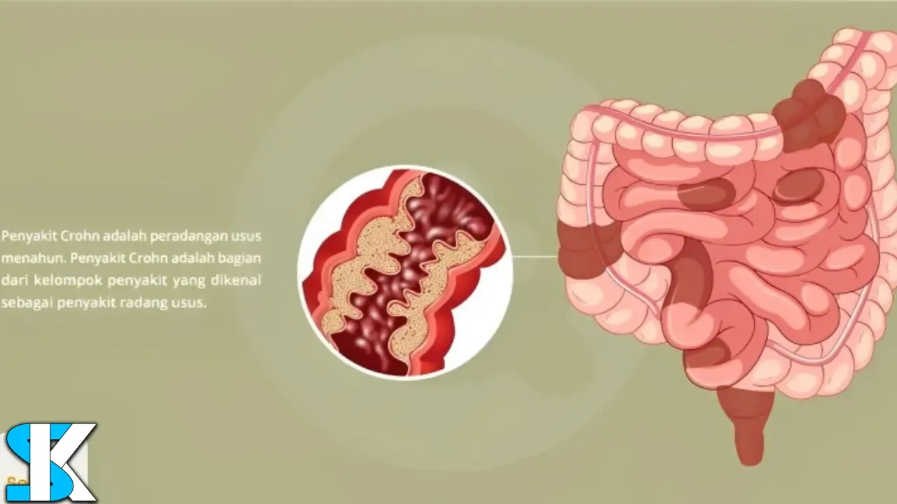 apa itu penyakit crohn