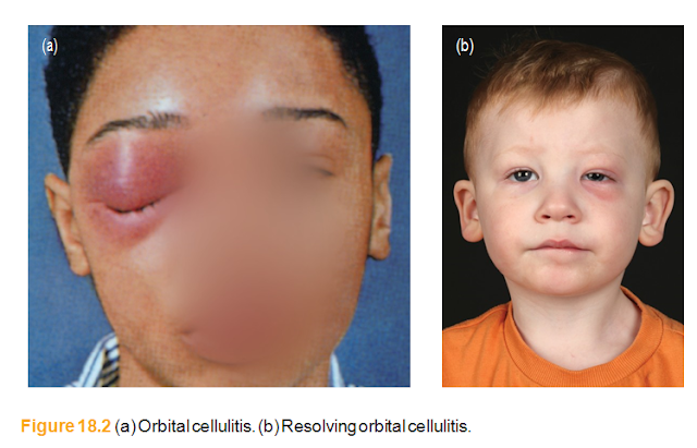 Orbital cellulitis. (b) Resolving orbital cellulitis.