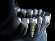 Dental implants Phoenix