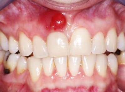 Dental abscess