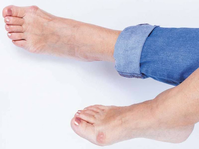 Diabetic Foot Ulcer Treatment Market