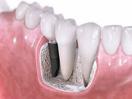 Trồng răng Implant có đau không có an toàn không?