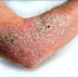 Obat alami penyakit gatal di kulit