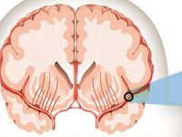 Tumbuhan Yang Bisa Mengobati Penyakit Stroke