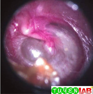 Otitis media with effusion in the left ear showing retraction of the tympanic membrane (TM) and straightening of the handle of the malleus as the retraction pulls the bone upward