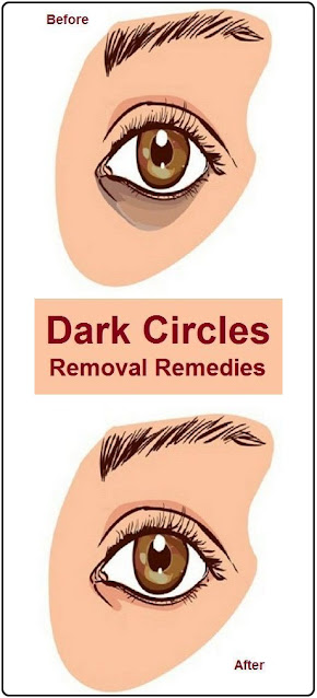 12 Simple Home Remedies to Remove Dark Circles Under Eyes Completely