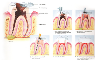 Rotary Endodontics Course, Endodontics Course India, Endodontic Courses in India, Endodontic Certificate Course