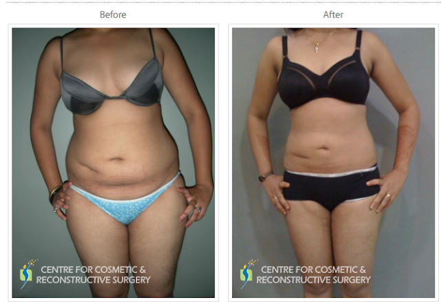 Liposuction in Mumbai