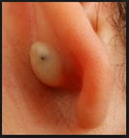 Pimple in Ear