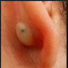 Causes and How To Treat Pimple in Ear