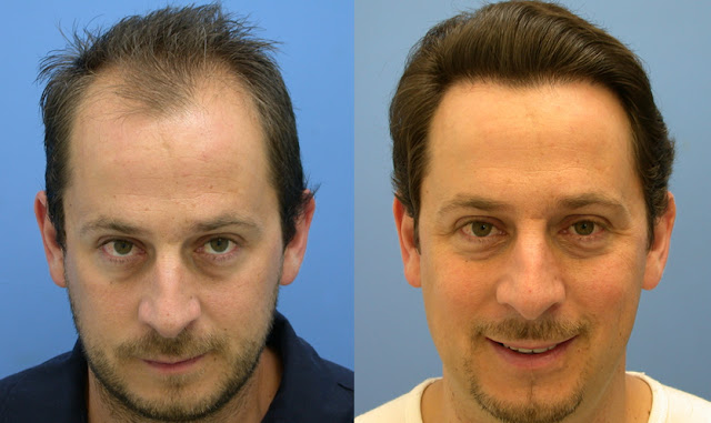 hair-transplant-techniques