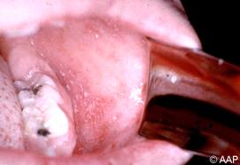 infectious bronchitis in rooster ppt