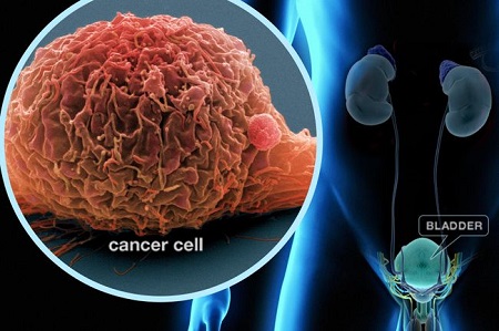 How to bladder cancer immunotherapy