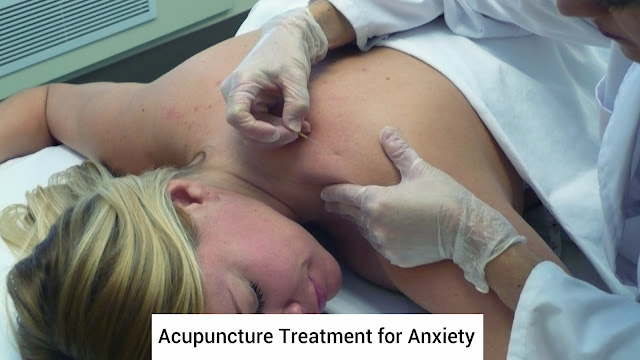 Acupuncture Treatment for Anxiety