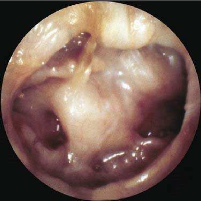 Middle-ear-atelectasis