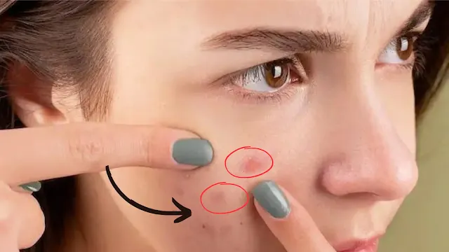 A girl cheek the acne on her face