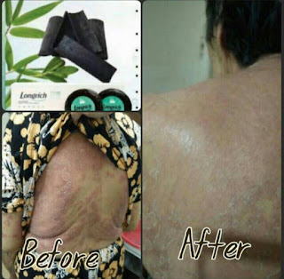 Psoriasis pada seluruh tubuh sembuh dengan menggunakan sabun arang bamboo longrich 