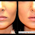 Lip augmentation