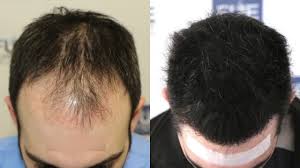 FUE hair transplant Islamabad