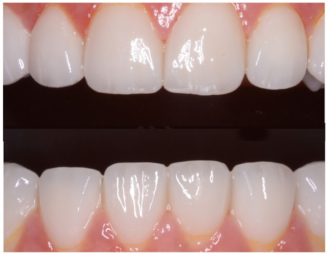 After Treatment of Smile Design with Ceramic Veneers