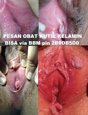 Penjual Obat Kutil Kelamin Di Kota Kediri