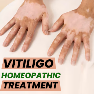 homeopathy medicine for vitiligo