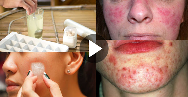 How To Use Ice On Acne Skin And Remove Acne Within 24 Hours