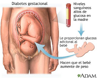 diabetes gestacional