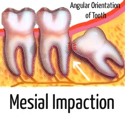 infected wisdom tooth pictures (mesial impaction)