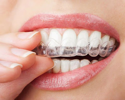 Niềng răng không mắc cài Invisalign thẩm mỹ