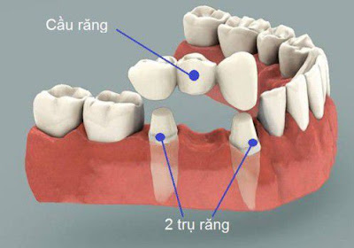 Ưu điểm khi làm cầu răng