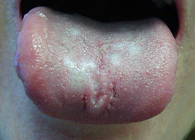 Candidiasis Of The Mouth : Hypothyroid Disease - Treatment  Relief Dr