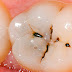 Răng hàm bị sâu nặng phải làm gì?
