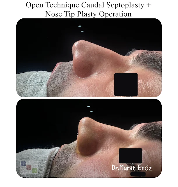 Open Technique Caudal Septoplasty + Nose Tip Plasty Anterior Septal Dislocation Nose Tip Lifting