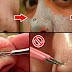 Get Rid Of Blackheads In No Time With These Easy Tips