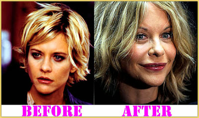 Meg Ryan Plastic Surgery before and after