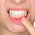 Cách khắc phục bọc răng sứ bị hở