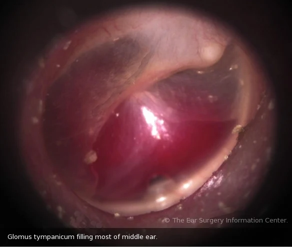 glomus-tumor-middle-ear-tympanicum