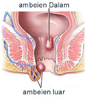 Penyebab Benjolan & Gatal di Anus serta Obat Benjolan & Gatal di Anus Tradisional