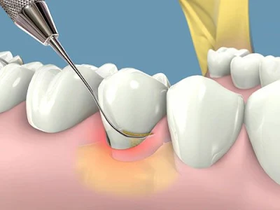 Vì sao nên cạo vôi răng theo định kỳ?