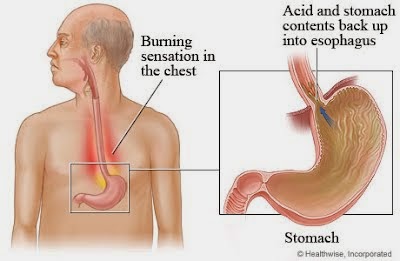 Cara Mengobati GERD Sampai Sembuh Total