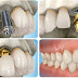 Các phương pháp làm răng giả có lâu không