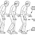 Parkinson Disease New treatments and benefits for patients