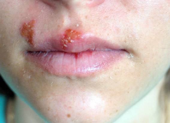 cara mengatasi penyakit herpes