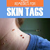 Home Remedies for Skin Tags
