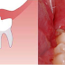 Răng khôn bị lợi trùm - Dấu hiệu nhận biết