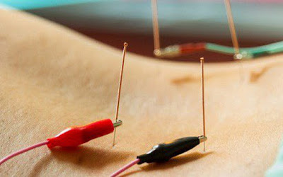 Acupuncture with Electrical Stimulation