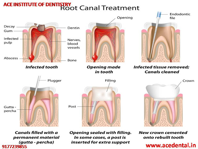 Dental Courses in India, General Dentistry Courses, Diploma Courses After BDS, Courses After BDS, Rotary Endodontics Course, Endodontics Course India,  Endodontic Courses in India, Endodontic Certificate Course, Dental Implant Courses in India, Dental Implantology Courses in India