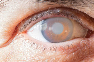 types of Cataract Surgery
