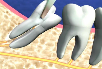 Quy trình niềng răng không nhổ răng